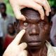 1 Billion People Will Be Blind By 2025- NOA