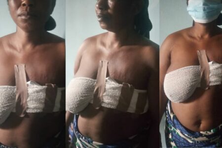 ‘Don’t Know What To Do’ — Lady Narrates Cancer Ordeal After Left Breast Cut Off