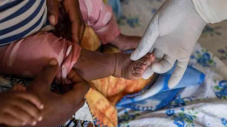 Sweden Reports First Case Of Contagious Mpox Variant